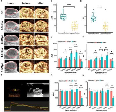 Tumor perfusion enhancement by microbubbles ultrasonic cavitation reduces tumor glycolysis metabolism and alleviate tumor acidosis